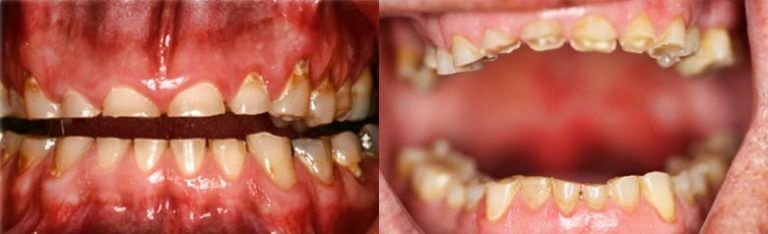 rechinar los dientes